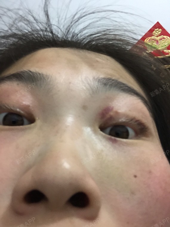通过新氧消费方案查看埋线双眼皮微创轻度疼痛双眼皮