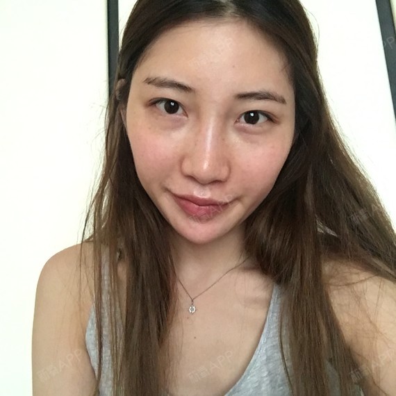 手术部位正面照:三张   素颜照片:没