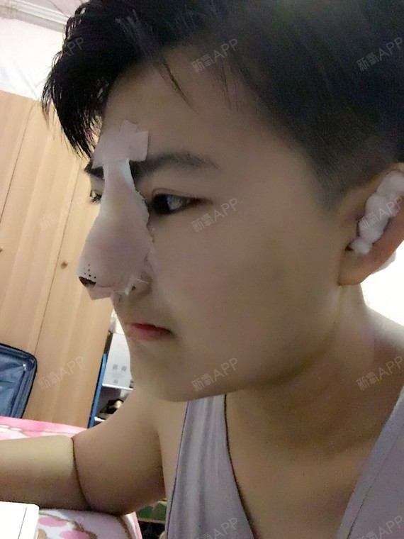 上次是在泰国做的单纯的隆鼻 没有鼻头 效果不好 这次