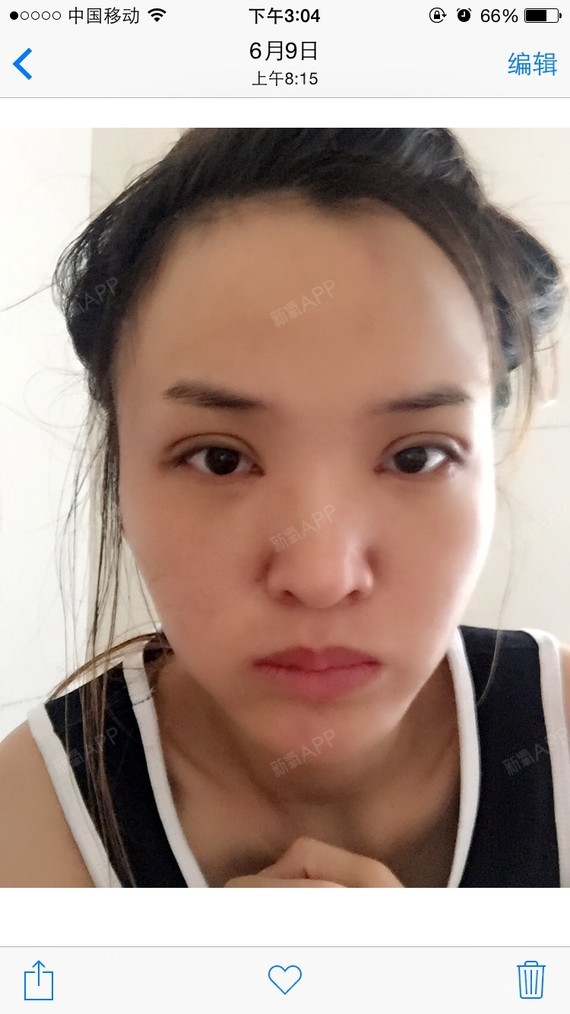 双眼皮