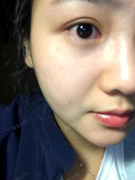 眼睑下至内切无疤,打造无辜大眼肇庆华美医学美容医院_圈子-新氧美容