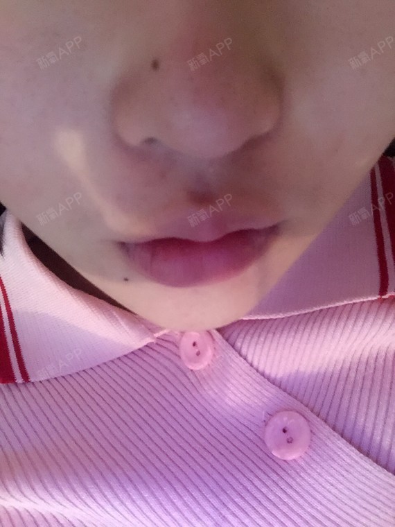 嘴唇打玻尿酸快一个月了还是硬块正常吗