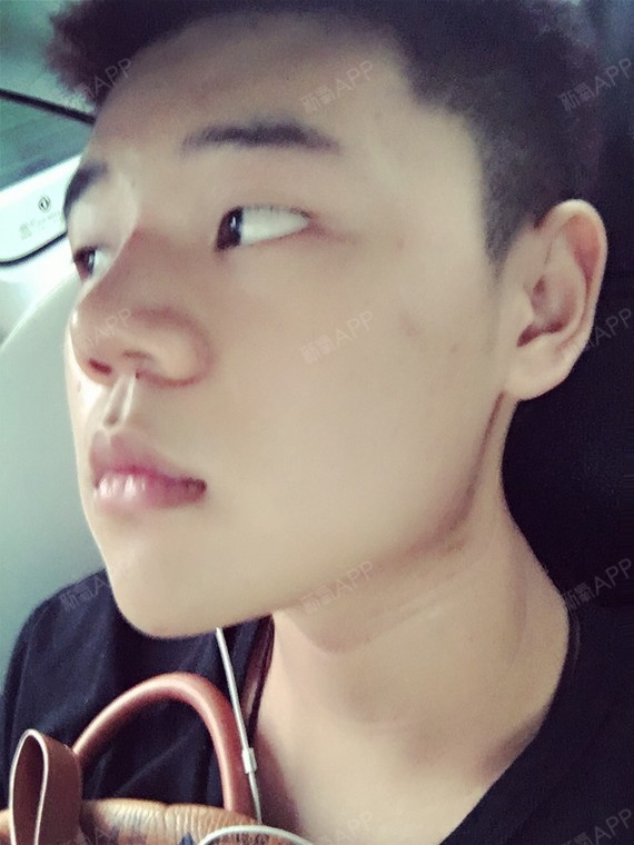 我的鼻梁很塌,鼻尖比较短又圆,鼻子看上去不是很好,_圈子-新氧美容