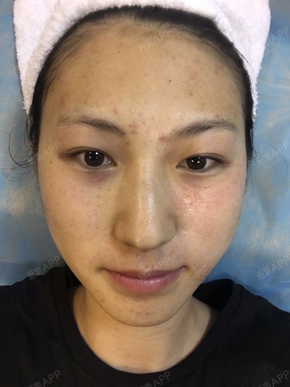 冯小皮水光针第7天美丽日记-新氧美容整形