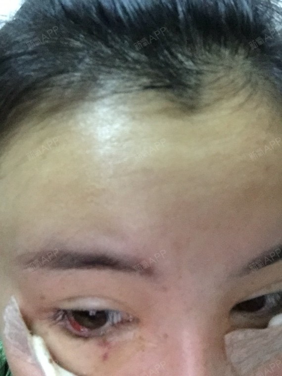 眼睛刚做完下至 5天 有一边眼睛里面有块小肉 会不会是失败了