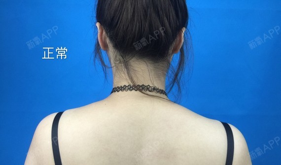 小红苹果阿阿康肉毒素瘦肩肌第0天美丽日记