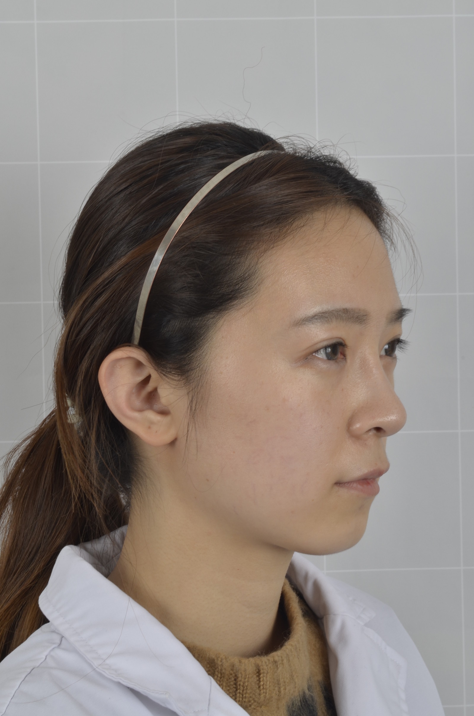 膨体隆鼻怎么样_沈阳伊美尔医疗美容医院的美丽日记_新氧整形