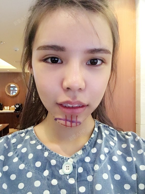 蓝色的是之前的下巴假体,真是歪到南京去了!