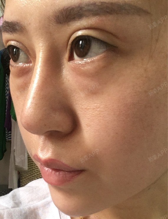 我这个眼袋,黑眼圈,泪沟,想找个专业人士帮忙看看……要怎么弄