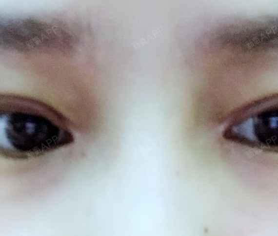 眼角20多天后一直是分叉的,这能恢复好吗_圈子-新氧美容整形