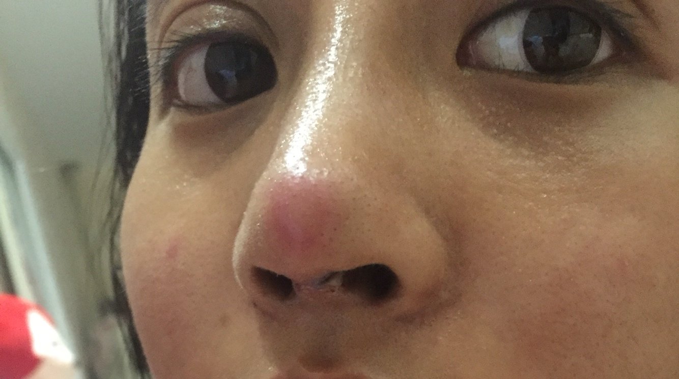 12号隆鼻发现鼻尖发红以为正常现象打了三天消炎针红肿依旧没退今天第