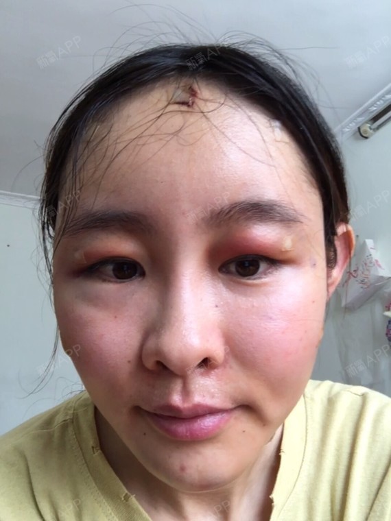 自体脂肪面部填充
