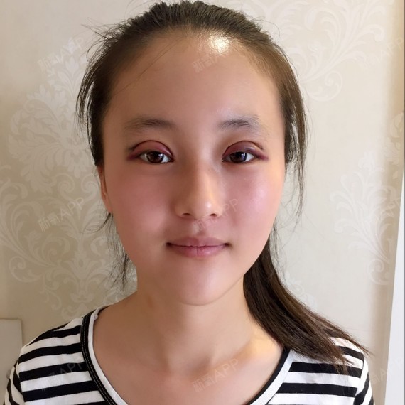 切开双眼皮好不好_效果图_天蓝色的切开双眼皮术后第1天_新氧美容整形