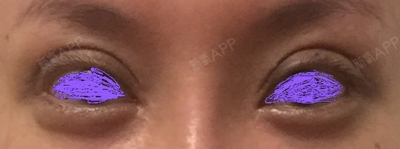 北京同仁医院孙强毁我眼睛双眼皮修复失败!