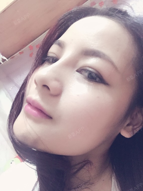 还不错就是下巴紫了,不知道要多久恢复.