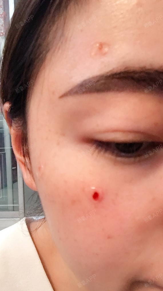 激光点痣好不好_效果图_facelin叶子激光点痣术后第0天_新氧美容整形