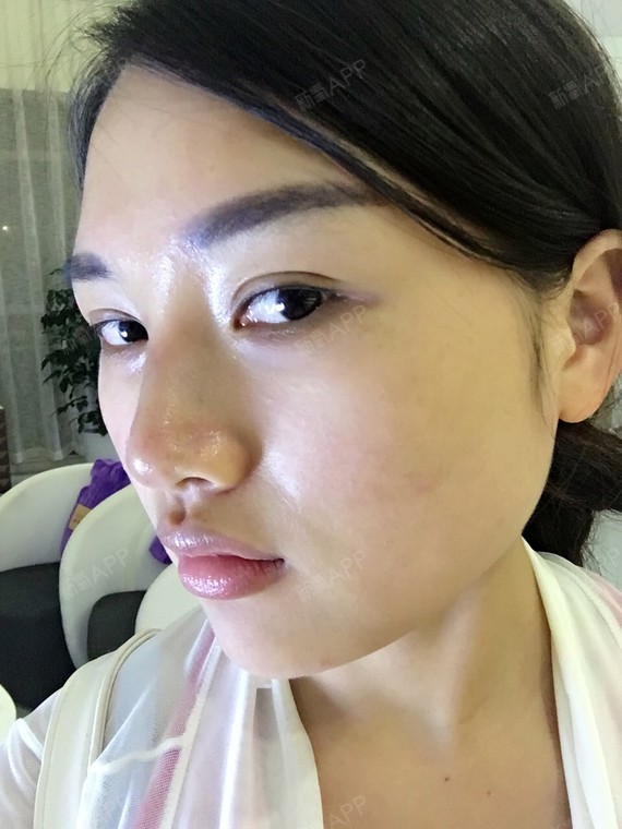 anne_489619玻尿酸隆鼻第0天美丽日记