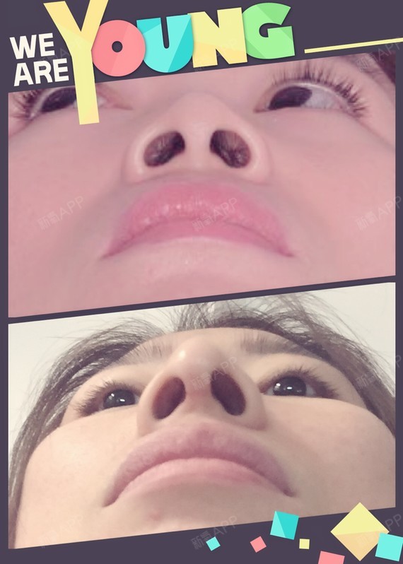发几张对比图吧,鼻小柱延长挺明显,假体也挺自然,就_圈子-新氧美容