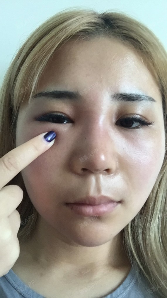 鼻子的山根越来越宽,打了溶解酶,第二天眼睛和脸都肿_圈子-新氧美容