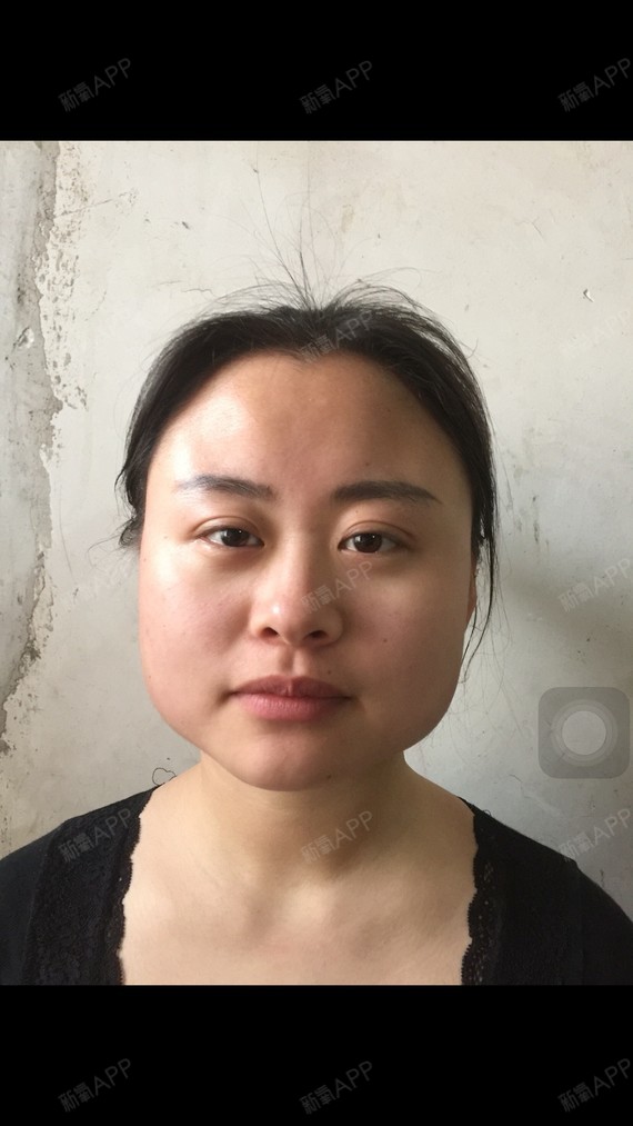 很多宝宝五官很美,但是顶着一张嫩牛五方脸,整个人都_圈子-新氧美容