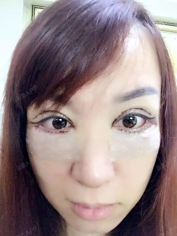 外切眼皮,眼袋20天了,硅胶隆鼻第10天,鼻子还肿着呢,期待满月