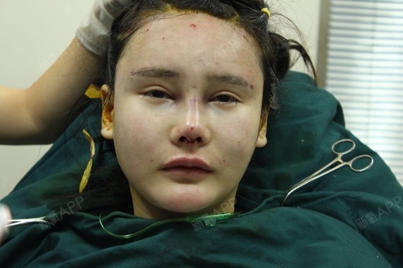 大连科美整形自体肋软骨自体脂肪填充全脸手术当天一开_圈子-新氧美容