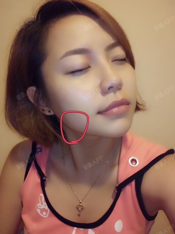 觉得左半边脸越来越肿了大家可以看最后一张图片不知道_圈子-新氧美容