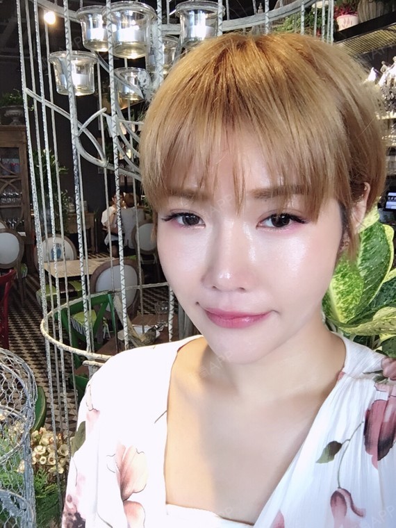 童颜针打完一个月了 很满意两颊的澎度 痘疤的地方也浅很多