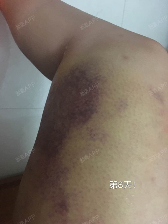以我日记为标准哦!淤青已经基本消除了!大腿也没那么肿胀啦!