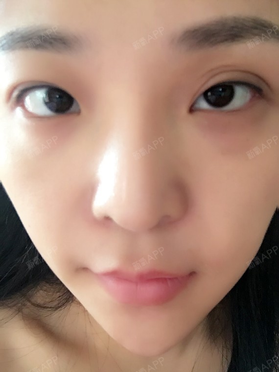 问答|【小眼睛如何打造明星同款"混血范儿"双眼皮】_圈子-新氧美容