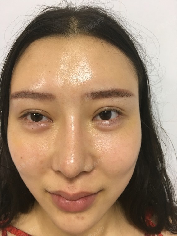 玻尿酸卧蚕术后即刻还有点肿消肿后更自然