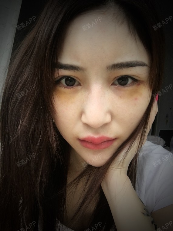 继续更新,离玻尿酸注射卧蚕已经第六天了,肿的很厉害_圈子-新氧美容