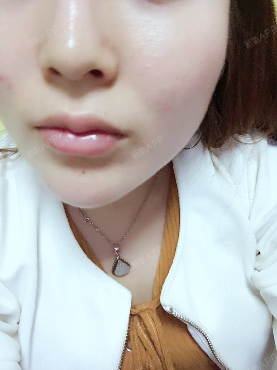 通过新氧消费方案查看玻尿酸丰唇注射无明显痛感唇型美化