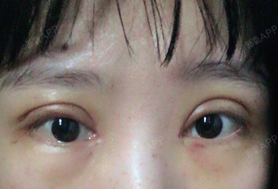 有点痒,不知道是昨天吃了豆腐干的问题