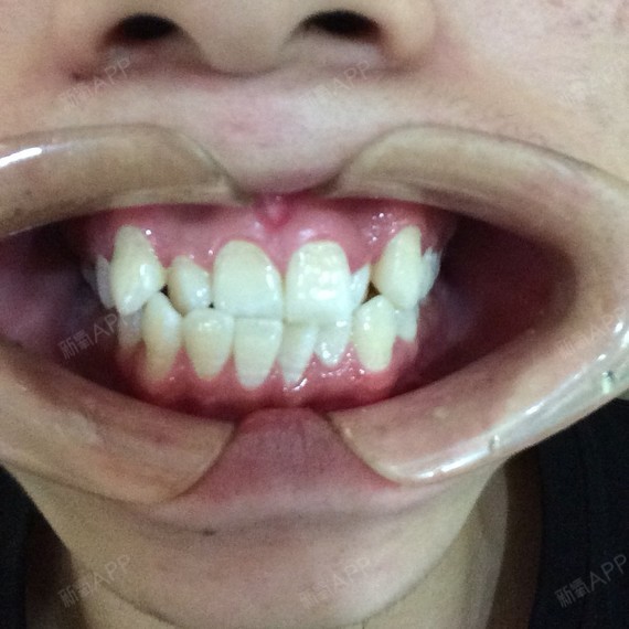 虽然和韩国整形没半毛钱关系,没去过其他医院不知道