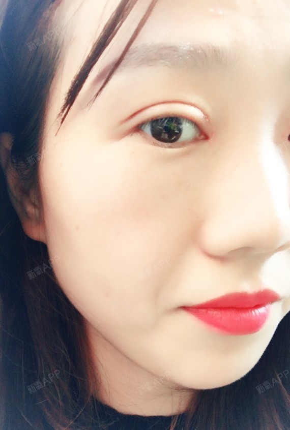 重庆开内眼角好不好_效果图_powyor开内眼角术后第16天_新氧美容整形