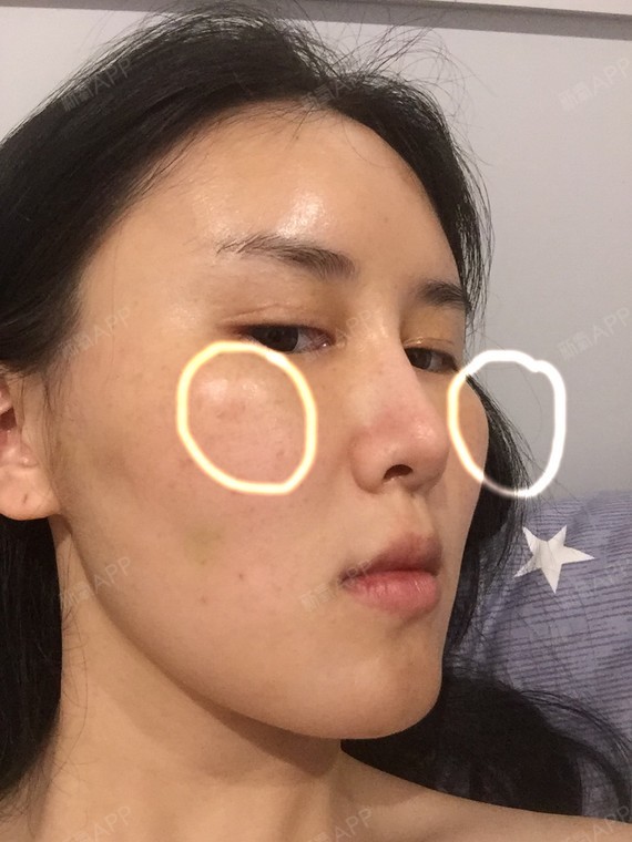北京自体脂肪丰泪沟好不好_效果图_麦兜兜自体脂肪丰泪沟术后第7天