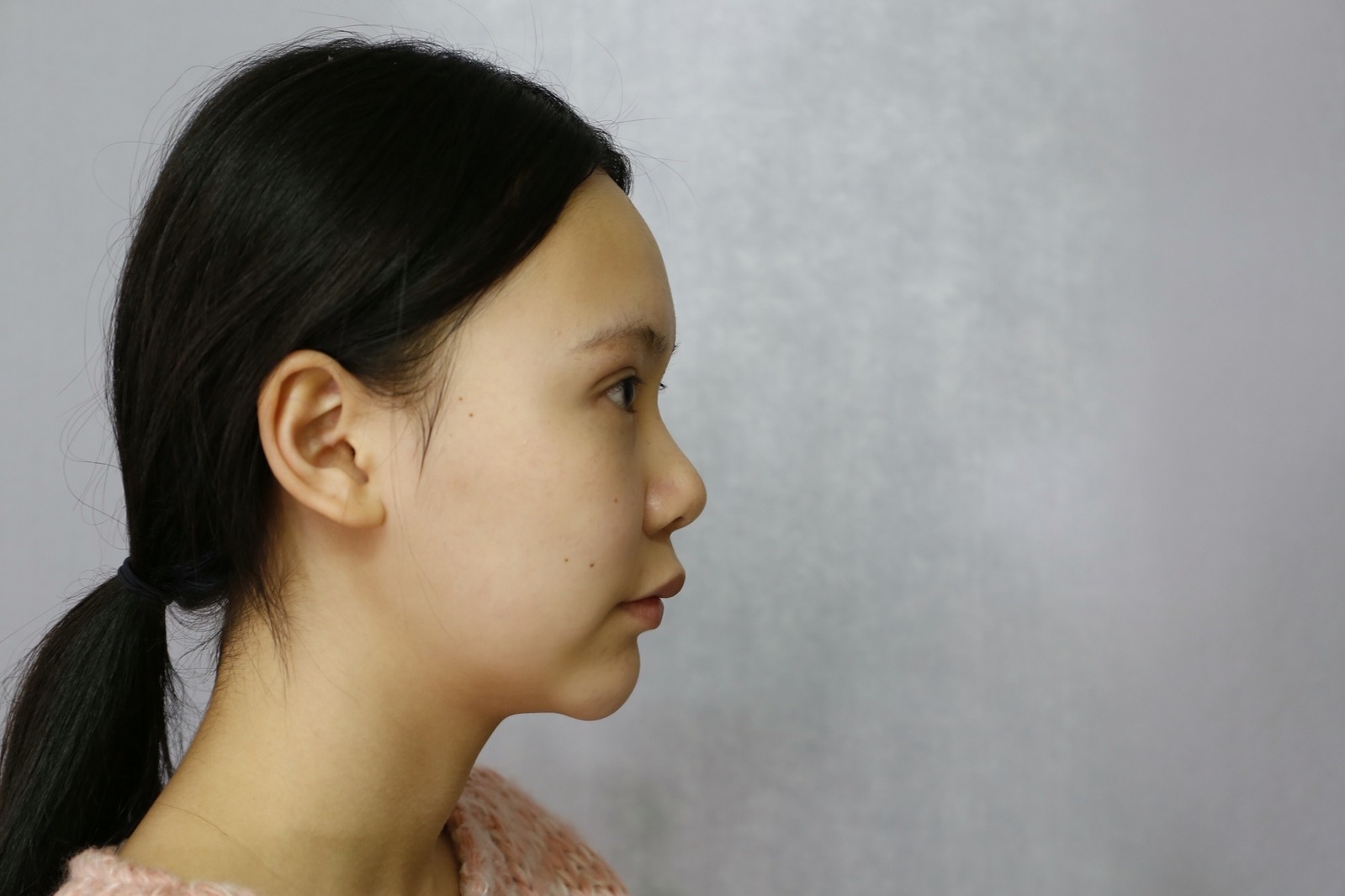肋软骨隆鼻优点那么多，为什么还是那么多人选择假体隆鼻？ - 知乎