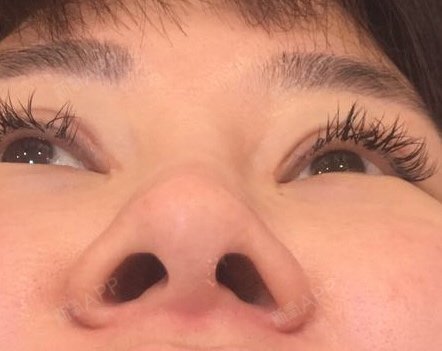 今天做了美思科蛋白线鼻小柱线做的时候不疼麻药过了现_圈子-新氧美容