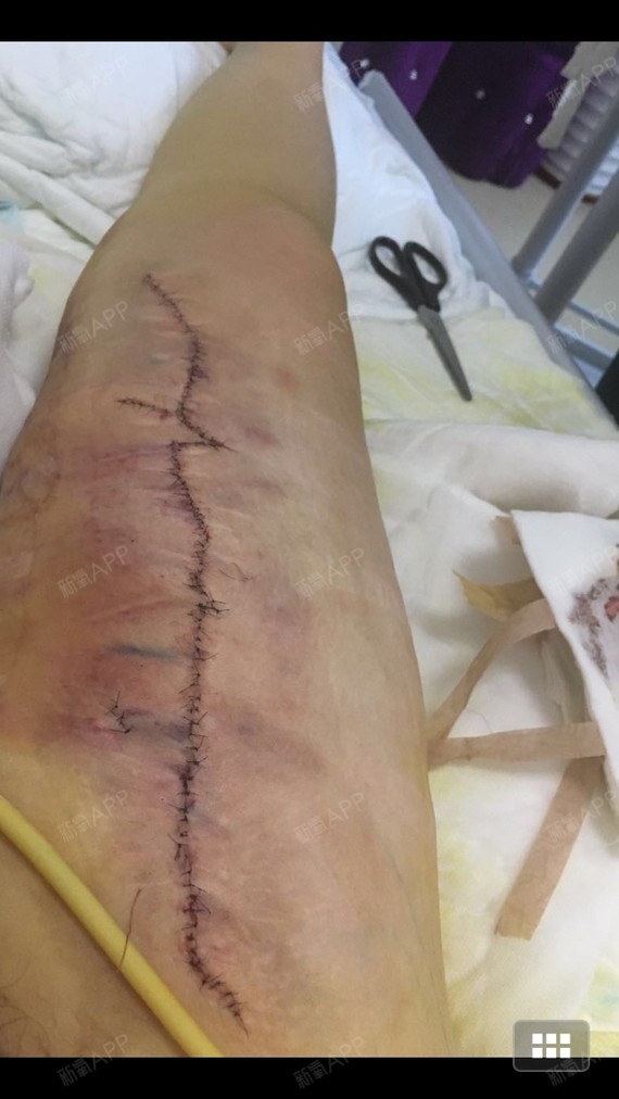 腿上的疤痕跟了我23年了总算切除掉了刚第三天还没拆_圈子-新氧美容