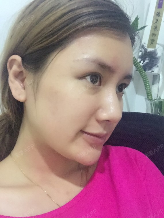kiki0316玻尿酸填充额头第460天美丽日记-新氧美容整形