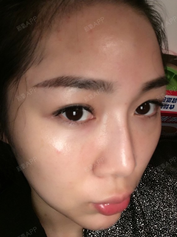 本身额头很饱满,但是两边眉骨上方有对称凹陷感,一皱_圈子-新氧美容
