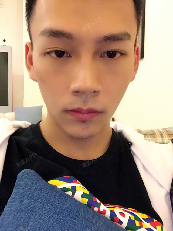 zhx1234玻尿酸垫下巴第0天美丽日记