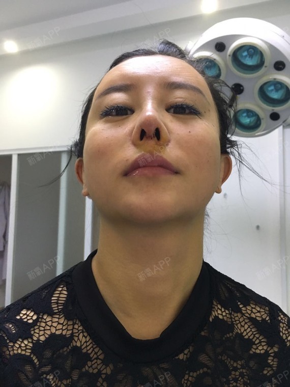 今天预约来做鼻子,特别特别忐忑.