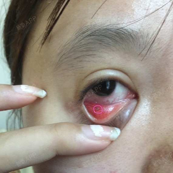 我大概两个礼拜之前做了眼睑下至手术,里面埋的有线,_圈子-新氧美容