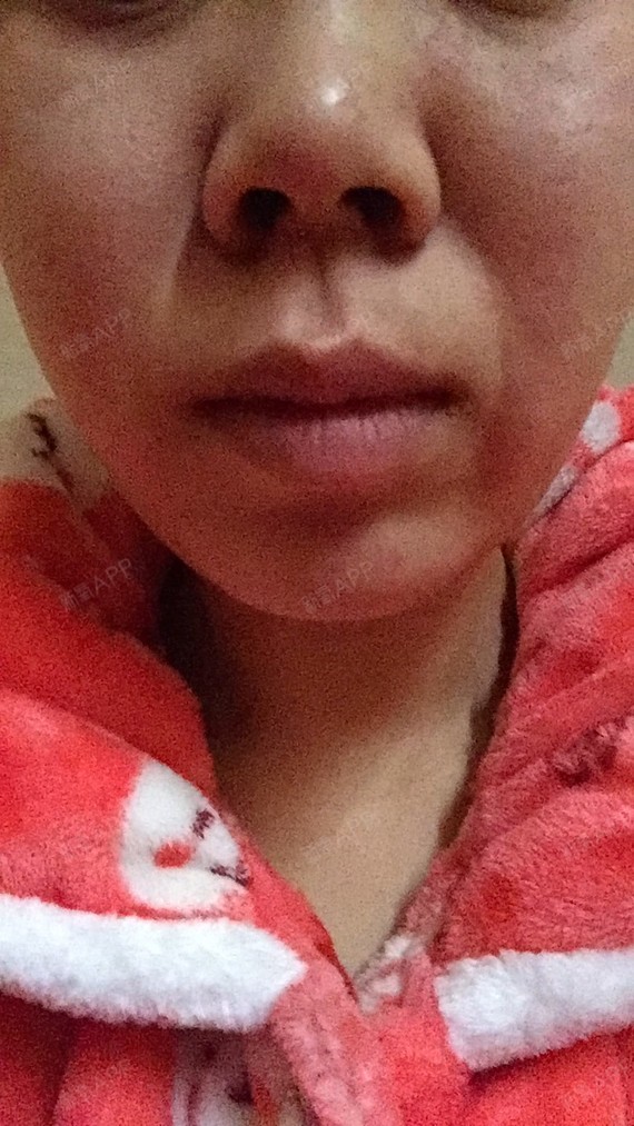 我的脸法令纹现在很严重,就是鼻唇沟那很深,属于先天_圈子-新氧美容