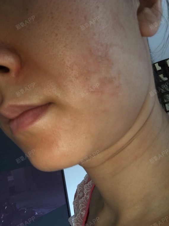 敷麻药灼伤图片_唇部敷麻药灼伤图片_麻药烧伤图片