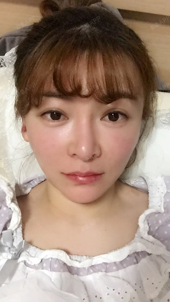 新氧- aimee_198613 | 唇部 | 激光美肤 | 薄唇 | 玻尿酸丰唇 | 微