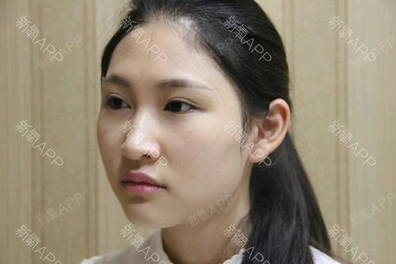 (2)罗马鼻:鼻根部凹陷稍深,鼻梁部的鼻骨处形成一段隆起,然后呈直线