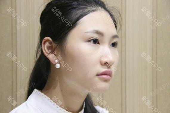 (2)罗马鼻:鼻根部凹陷稍深,鼻梁部的鼻骨处形成一段隆起,然后呈直线